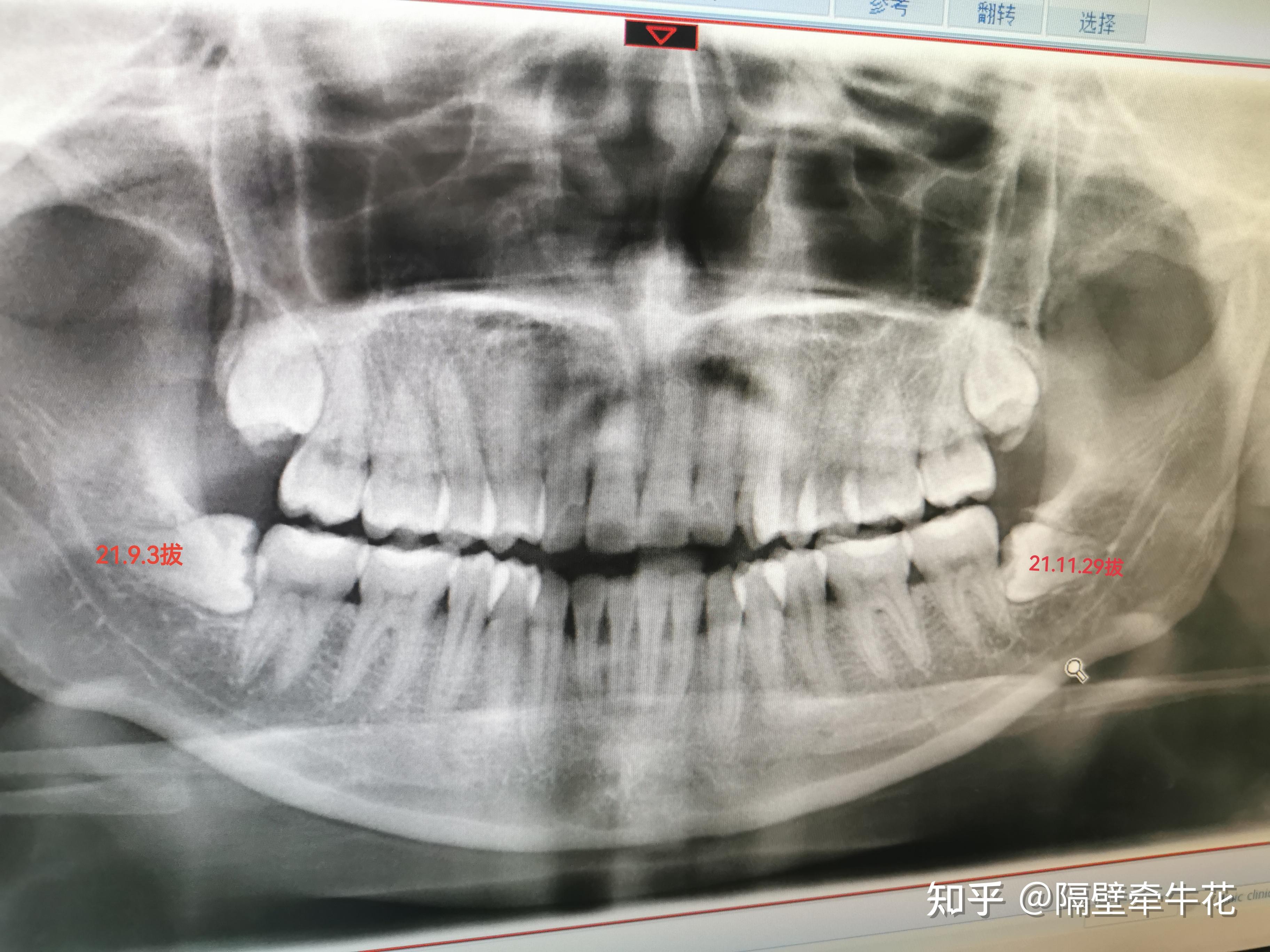 广东省口腔智齿牵引广东省口腔智齿牵引技术，引领现代口腔医疗的新篇章