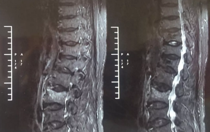 轻微压缩性骨折半个月轻微压缩性骨折半个月，恢复之路与应对策略