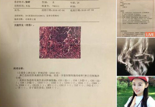 淋巴癌死亡前一个月淋巴癌死亡前一个月，深度探究与人文关怀