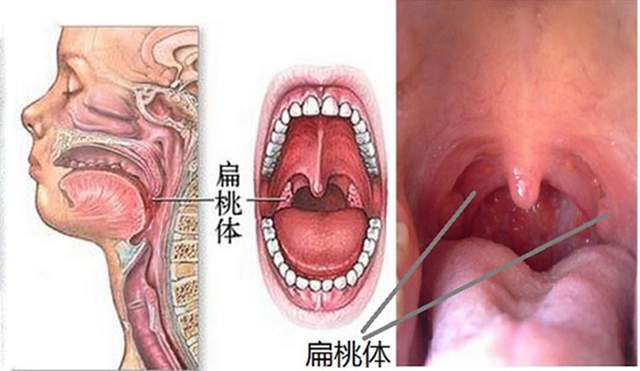 舌缘发炎一个月舌缘发炎一个月，成因、症状与治疗方法